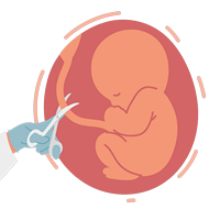 Cutting of Umbilical Cord of Newborn